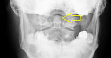 Hairline Fracture of C2 Ondontoid found by Medical Intuitive